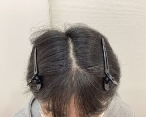 AGA治療2年後 43歳男性 生え際改善 新潟院
