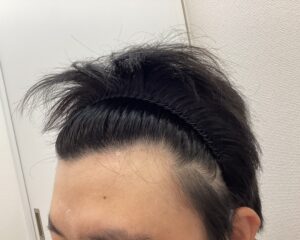 AGA治療6ヵ月後　28歳男性　前頭部改善　新潟院