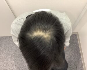 AGA治療8ヵ月後 25歳男性 前頭・頭頂部改善 新潟院