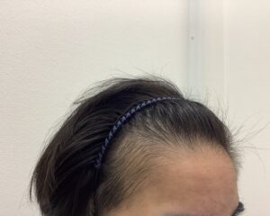 AGA治療8ヵ月後 25歳男性 前頭・頭頂部改善 新潟院