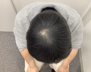 AGA治療1年4ヵ月後　28歳男性　頭頂部改善　新潟院