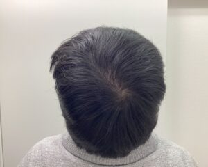 AGA治療1年4ヵ月後　28歳男性　頭頂部改善　新潟院