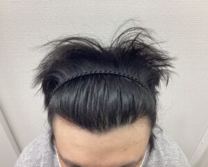 AGA治療1年4ヵ月後　28歳男性　前頭部改善　新潟院