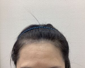 FAGA1年5ヵ月後　57歳女性　生え際・分け目改善　新潟院