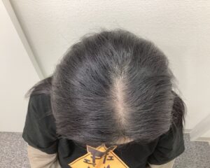 FAGA1年5ヵ月後　57歳女性　生え際・分け目改善　新潟院
