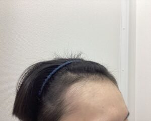 AGA治療11ヵ月後　27歳男性　生え際改善　新潟院