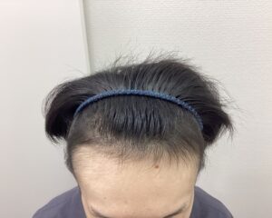 AGA治療11ヵ月後　27歳男性　生え際改善　新潟院