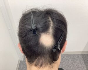 AGA治療1ヶ月後｜33歳男性｜生え際改善・円形脱毛症改善｜新潟院