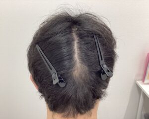 AGA治療4か月半後｜33歳男性｜生え際改善・円形脱毛症改善｜新潟院