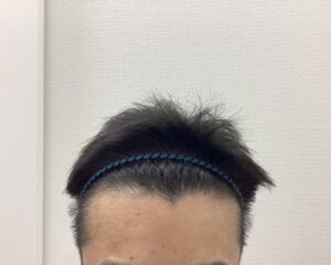 AGA治療5ヵ月後　44歳男性　生え際・頭頂部改善　新潟院