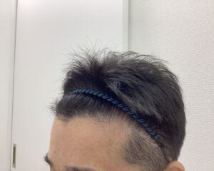AGA治療5ヵ月後　44歳男性　生え際・頭頂部改善　新潟院