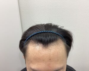 AGA治療6ヵ月後　27歳男性　生え際・頭頂部改善　新潟院