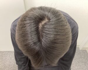 AGA治療6ヵ月後　27歳男性　生え際・頭頂部改善　新潟院