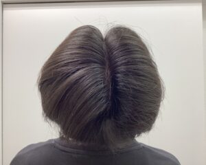 AGA治療6ヵ月後　27歳男性　生え際・頭頂部改善　新潟院