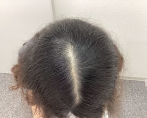 FAGA6ヵ月後　20歳女性　生え際・頭頂部改善　新潟院