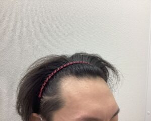 AGA治療前　35歳男性　生え際の薄毛　新潟院