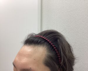 AGA治療前　35歳男性　生え際の薄毛　新潟院
