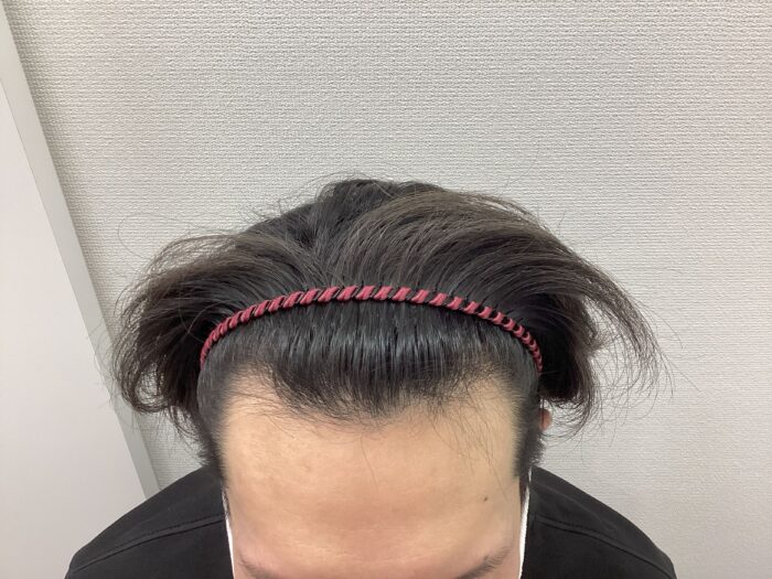 【35歳男性】生え際の薄毛がAGA治療で改善｜新潟院
