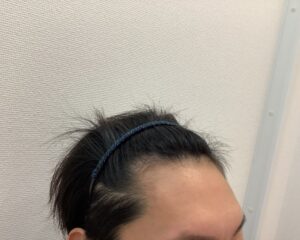 AGA治療5ヵ月後　35歳男性　生え際改善　新潟院