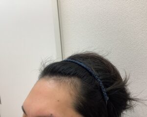 AGA治療5ヵ月後　35歳男性　生え際改善　新潟院