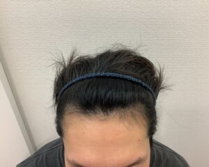 AGA治療5ヵ月後　35歳男性　生え際改善　新潟院