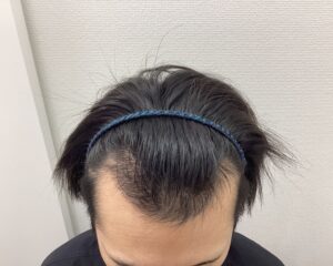 AGA治療4ヵ月後　26歳男性　前頭・頭頂部改善　新潟院