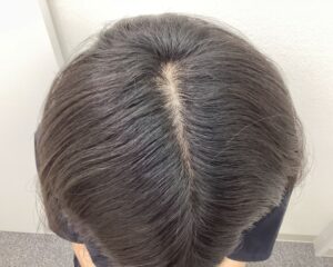 AGA治療4ヵ月後　26歳男性　前頭・頭頂部改善　新潟院