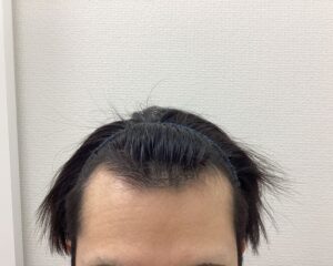 AGA治療4ヵ月後　26歳男性　前頭・頭頂部改善　新潟院