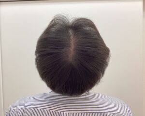 AGA治療経過良好時　59歳男性　頭頂部改善　新潟院