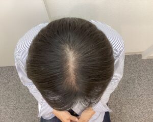 AGA治療経過良好時　59歳男性　頭頂部改善　新潟院