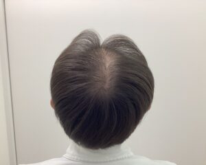 約6か月休薬後　59歳男性　頭頂部薄毛　新潟院