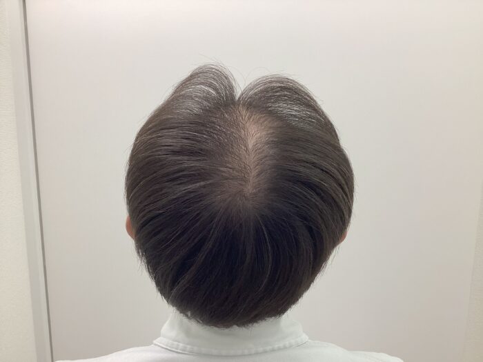 【59歳男性】休薬後に進行した薄毛が治療再開で改善｜新潟院