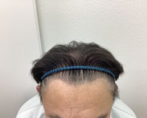 約6か月休薬後　59歳男性　頭頂部薄毛　新潟院