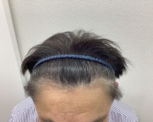 AGA治療再開後　59歳男性　頭頂部改善　新潟院