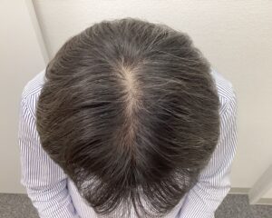 AGA治療再開後　59歳男性　頭頂部改善　新潟院