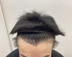AGA治療前　44歳男性　生え際・頭頂部薄毛　新潟院