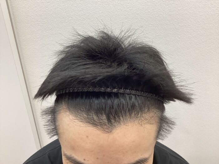 【44歳男性】生え際・頭頂部の薄毛がAGA治療で改善｜新潟院