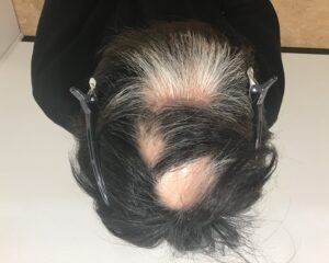 多発型円形脱毛症治療前　34歳男性　頭頂部薄毛　千葉津田沼院