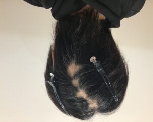 多発型円形脱毛症治療前　34歳男性　後頭部薄毛　千葉津田沼院
