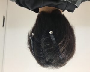 多発型円形脱毛症治療6ヶ月後　34歳男性　後頭部　千葉津田沼院