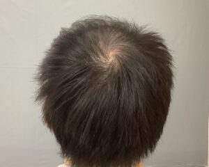 AGA治療前　31歳男性　頭頂部薄毛　金沢院