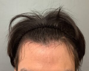 AGA治療6カ月後　20歳男性　頭頂部・生え際改善　金沢院