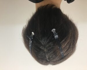 多発型円形脱毛症治療12ヶ月後　34歳男性　後頭部改善　千葉津田沼院