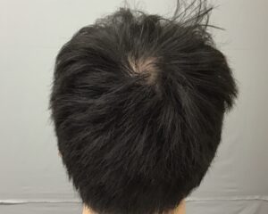AGA治療8ヶ月後　31歳男性　頭頂部改善　金沢院