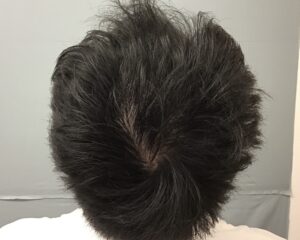 AGA治療8ヶ月後　31歳男性　頭頂部改善　金沢院