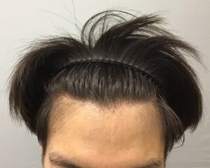 AGA治療6カ月後　20歳男性　頭頂部・生え際改善　金沢院