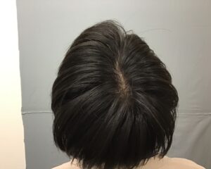 AGA治療6カ月後　20歳男性　頭頂部・生え際改善　金沢院