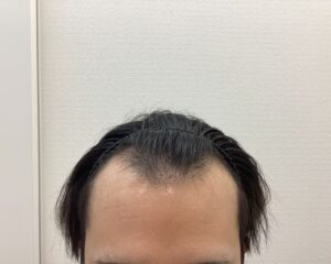 AGA治療前　26歳男性　前頭・頭頂部薄毛　新潟院
