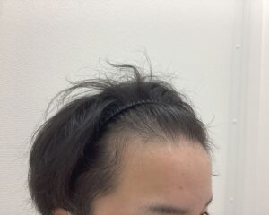 AGA治療前 25歳男性 前頭・頭頂部薄毛 新潟院