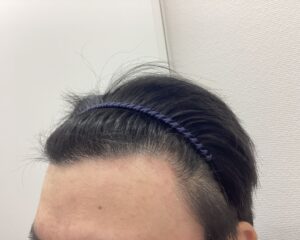 AGA治療前　28歳男性　前頭部薄毛　新潟院